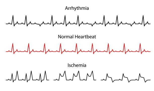 Fibrilación auricular: diagnóstico y nuevas estrategias en el manejo anticoagulante