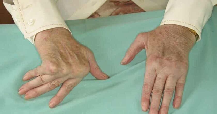 Artritis reumatoide: de los FAMEs a la medicina de precisión.