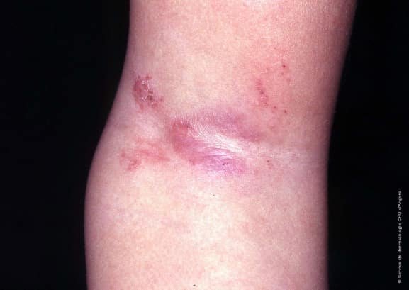 Dermatitis atópica: avances en el manejo y nuevas terapias biológicas.