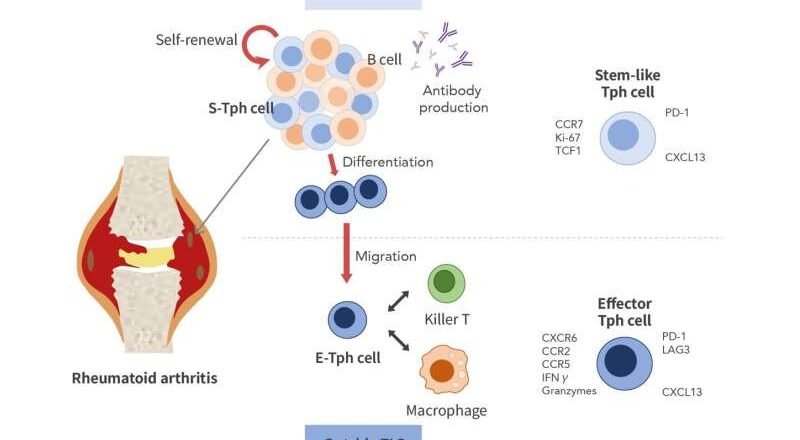 Científicos descubren «centros» inmunitarios ocultos que provocan daño articular en la artritis reumatoide
