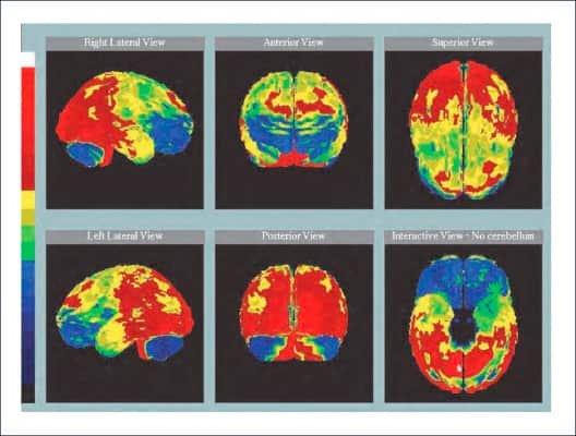 Avances en la investigación del Alzheimer: terapias emergentes y biomarcadores.