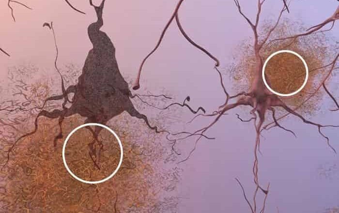Neurodegeneración y Alzheimer: nuevos biomarcadores y terapias en desarrollo.