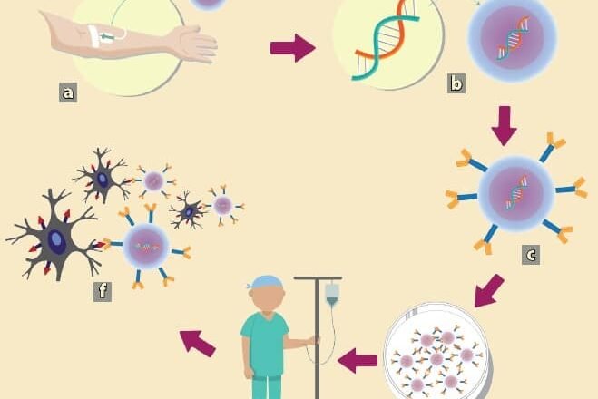 CAR-T en linfoma difuso de células B grandes: de la terapia de rescate a la primera línea 🧬🧑‍⚕️💉