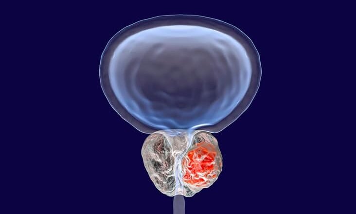 Radioligandos PSMA con Lutecio-177: la revolución en el cáncer de próstata avanzado 🧬⚛️👨‍⚕️