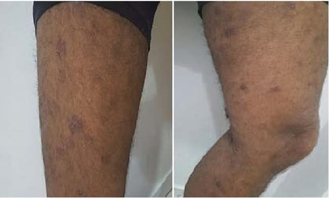 Inhibidores JAK en dermatitis atópica: eficacia sostenida y dudas de seguridad a largo plazo 🧴💊⚠️