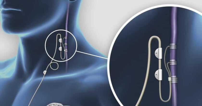 Epilepsia resistente a fármacos: retos clínicos y terapias emergentes