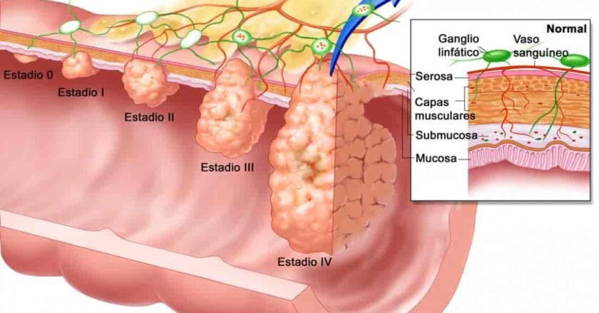 Cáncer de colon: ctDNA confirma a 5 años su valor para guiar la terapia adyuvante 🧬🩸🎯