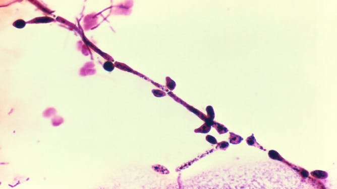 ¿Por qué la candidiasis vaginal continúa siendo un problema médico tan frecuente?