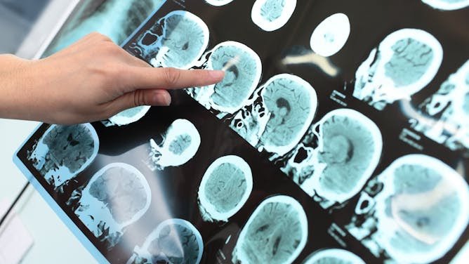 Así es el primer tratamiento contra el alzheimer que se puede administrar en casa