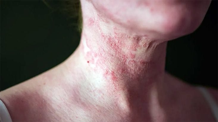 Dermatitis atópica en adultos: factores desencadenantes y nuevos tratamientos