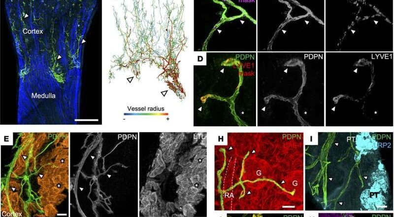 El rechazo del trasplante de riñón se asocia con cambios en los vasos linfáticos, según muestra una nueva investigación