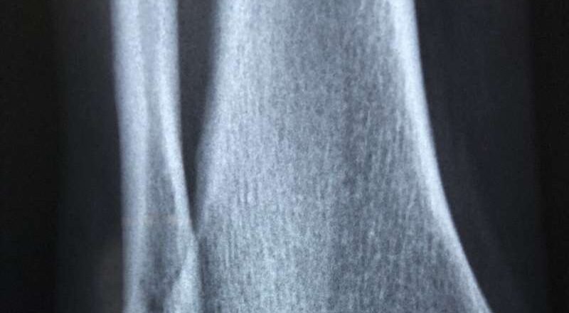 Los medicamentos aprobados para tratar el dolor también podrían reducir el crecimiento del cáncer óseo