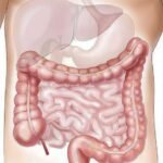 El sangrado rectal en adultos jóvenes se relaciona con un riesgo 8,5 veces mayor de cáncer colorrectal