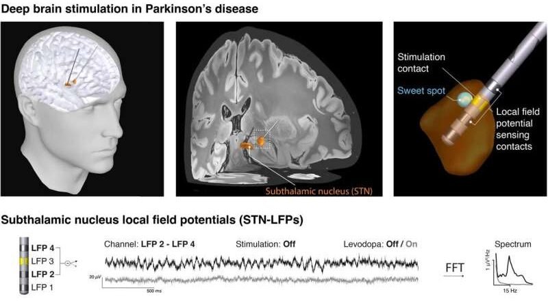 Se ha identificado una nueva firma eléctrica de la enfermedad de Parkinson