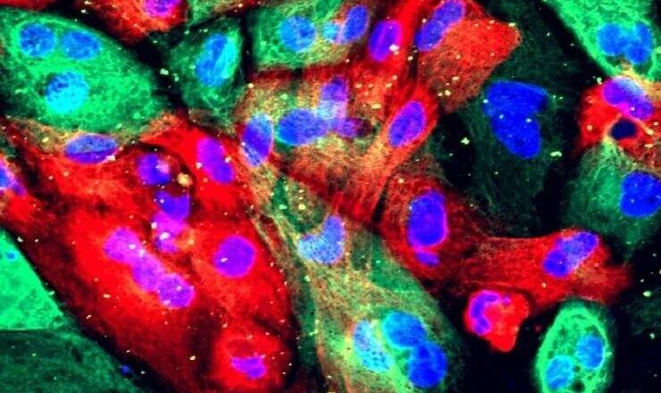 Dirigir enzimas para debilitar las células cancerosas podría potenciar el tratamiento del cáncer de próstata