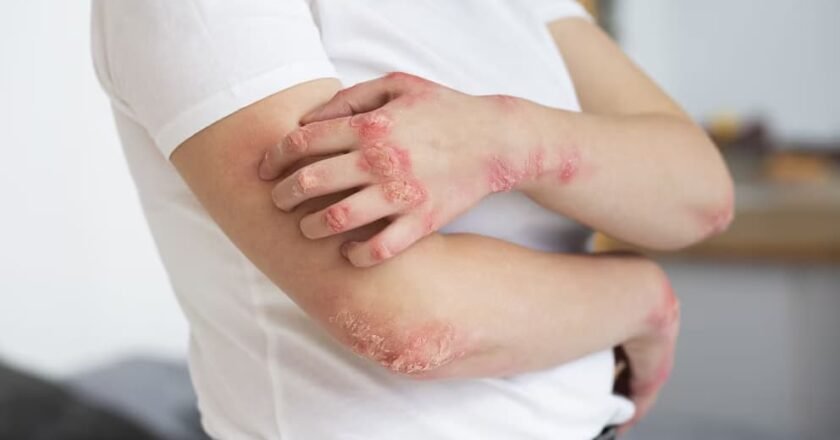 Un tratamiento temprano impacta en la evolución de la psoriasis y previene daños articulares a largo plazo