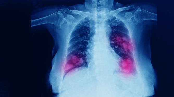 La edición genética podría desactivar a uno de los principales culpables del cáncer de pulmón