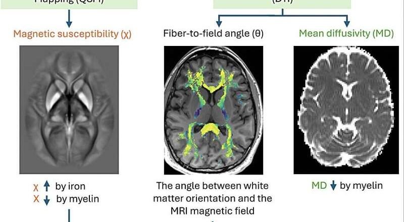 Un estudio de neuroimagen revela que la esquizofrenia está relacionada con déficits de hierro y mielina en el cerebro