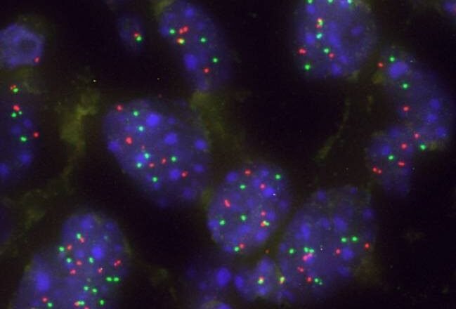 Una proteína clave que frena la progresión del cáncer de pulmón