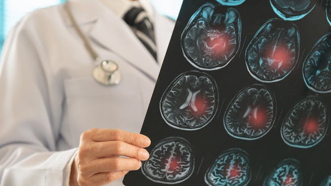 Terapia con células madre: ¿una nueva era en la regeneración cerebral después de un ictus?