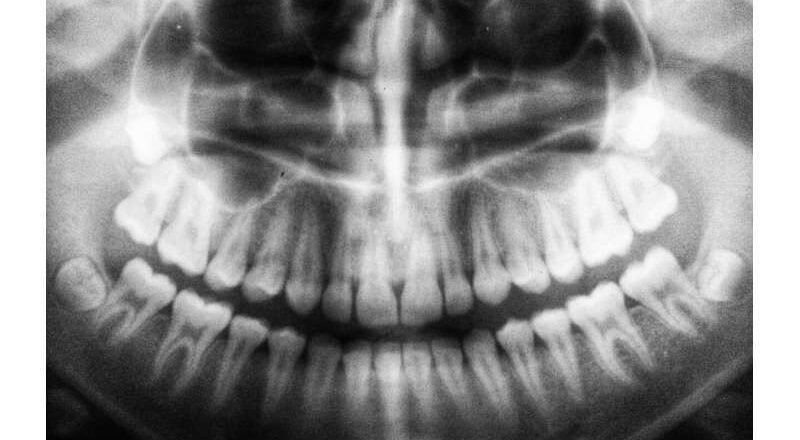 Endodoncias y azúcar en sangre: La conexión de la que probablemente no has oído hablar