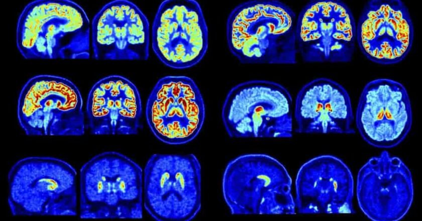 Nuevo escáner PET permite detectar trastornos cerebrales con mayor precisión y antelación