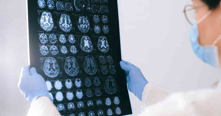 Un nuevo enfoque en la lucha contra el Alzheimer: fármacos en evaluación e imágenes cerebrales de alta precisión
