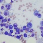 Fármacos oncológicos podrían abrir una nueva vía de tratamiento para la anemia de Diamond-Blackfan