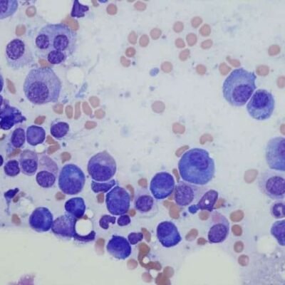 Fármacos oncológicos podrían abrir una nueva vía de tratamiento para la anemia de Diamond-Blackfan