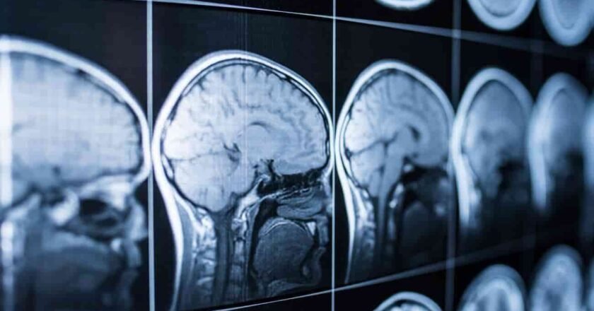 Cómo afecta un ictus a la comprensión del habla: nuevas claves desde el cerebro
