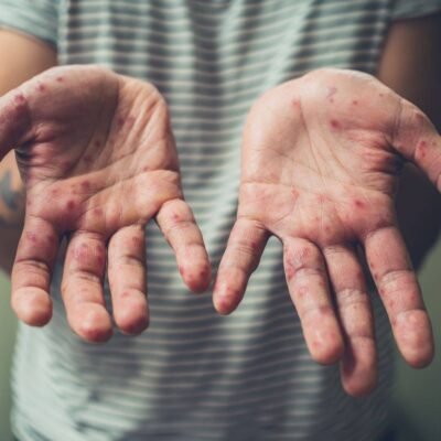 España pierde el estatus de país libre de sarampión: qué implica para la salud pública