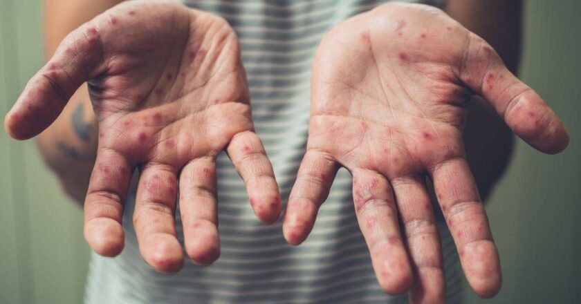 España pierde el estatus de país libre de sarampión: qué implica para la salud pública