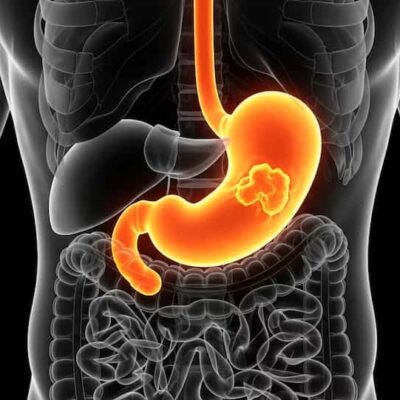 Un estudio internacional revela factores de riesgo silenciosos del cáncer de estómago