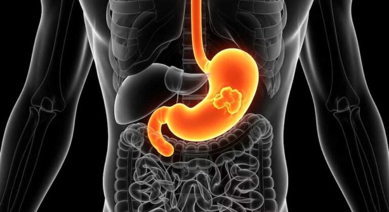 cancer de estomago 28-1-26