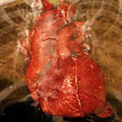 Investigación biomédica internacional: el cerebro y el nervio vago pueden agravar el daño tras un infarto