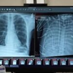 Un avance médico en Estados Unidos permitió que un paciente sobreviviera 48 horas sin pulmones