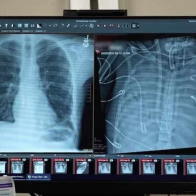 Un avance médico en Estados Unidos permitió que un paciente sobreviviera 48 horas sin pulmones