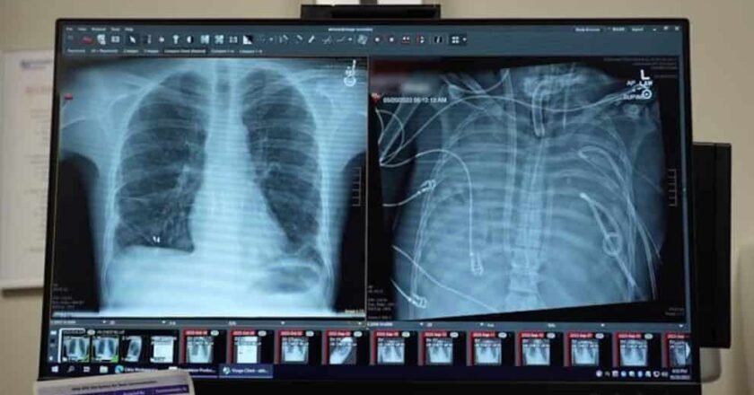 Un avance médico en Estados Unidos permitió que un paciente sobreviviera 48 horas sin pulmones