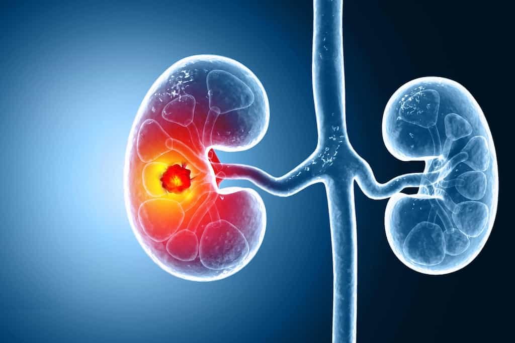 Cáncer de riñón en Argentina: el tumor silencioso que exige controles a tiempo