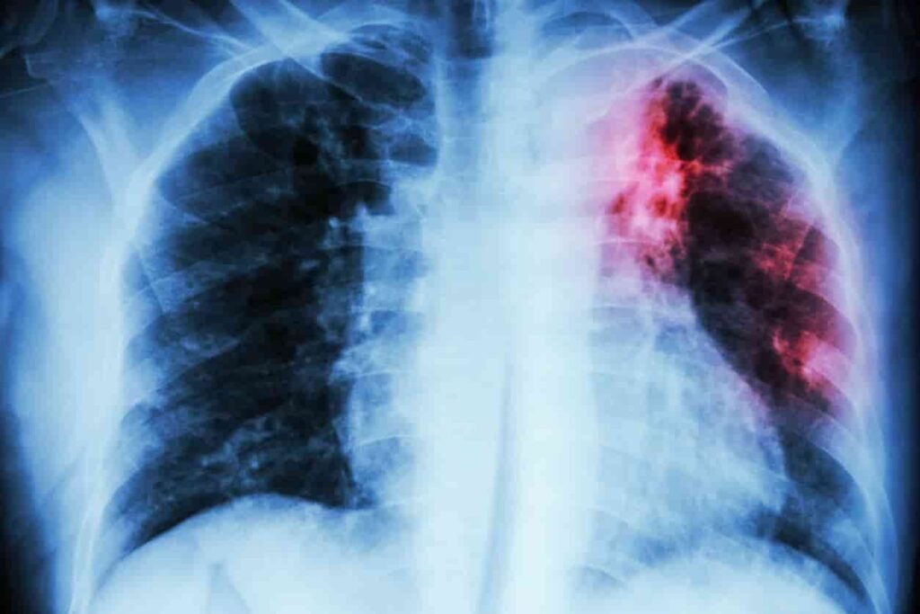 Detectan variantes genéticas inéditas de la tuberculosis