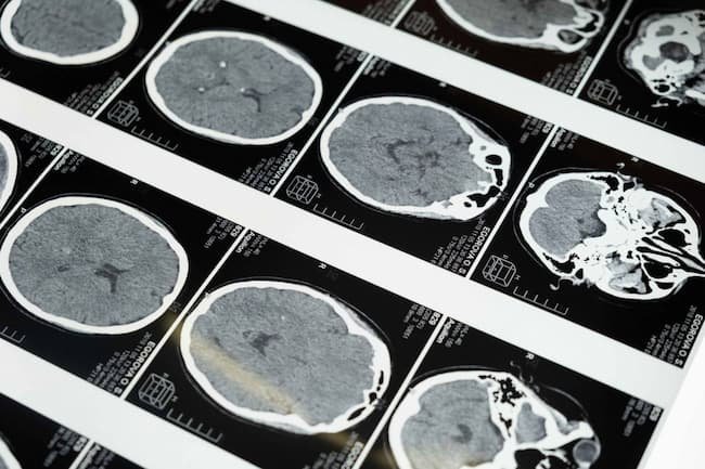 Microtrombos en el cerebro abren otra vía frente al Alzheimer