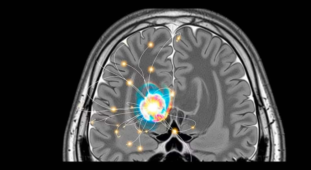 Cáncer y Alzheimer: la paradoja que abre nuevas vías de investigación