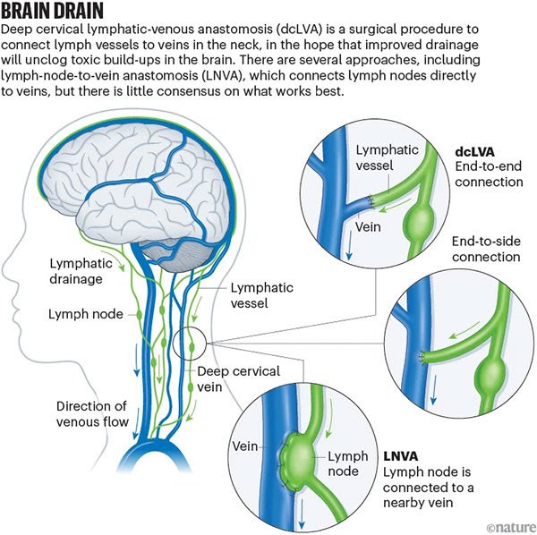Cirugía para el Alzheimer avanza entre dudas científicas