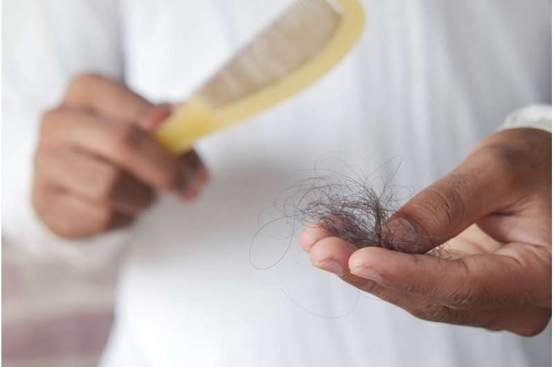 Medicamento contra la artritis impulsa el crecimiento capilar en alopecia grave