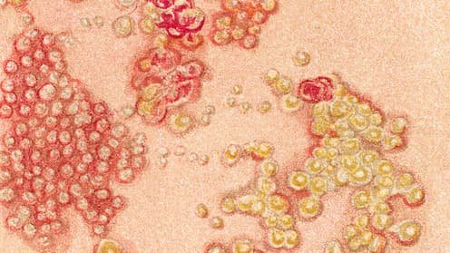 Herpes zóster: un riesgo vascular que va más allá de la piel
