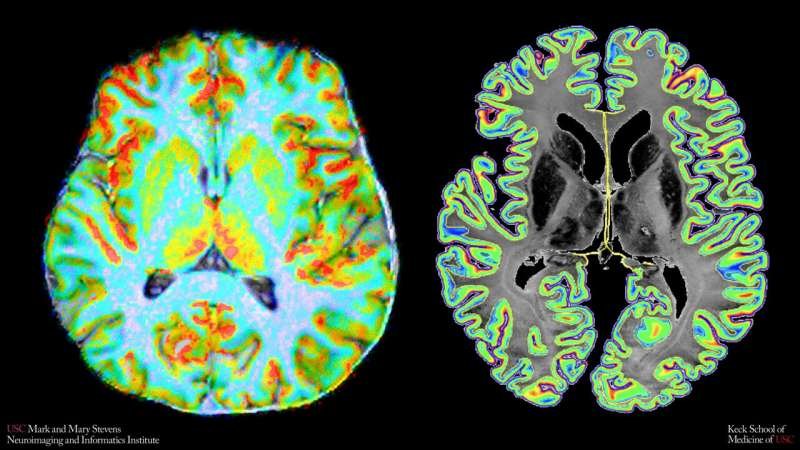 Una resonancia revela cómo se distribuye la sangre entre las capas del cerebro