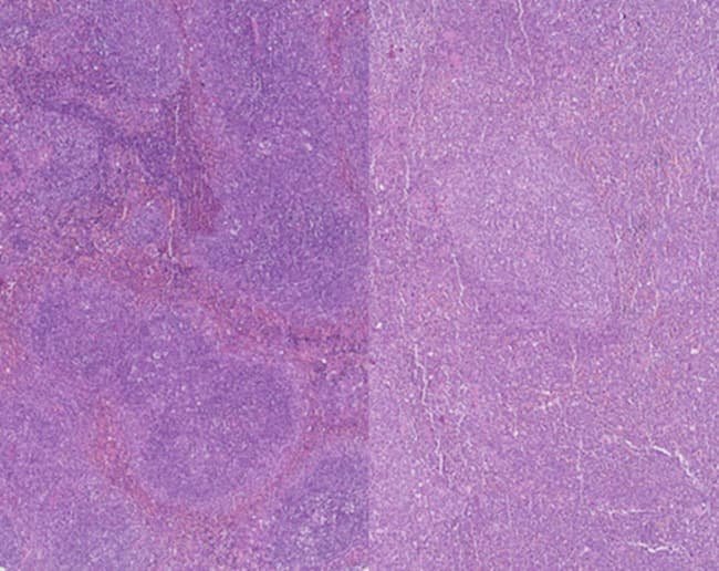 Seis genes permiten anticipar el pronóstico de la leucemia aguda