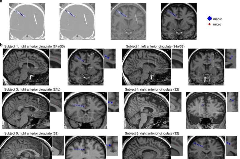 Una región oculta del cerebro detecta errores en nuestras expectativas