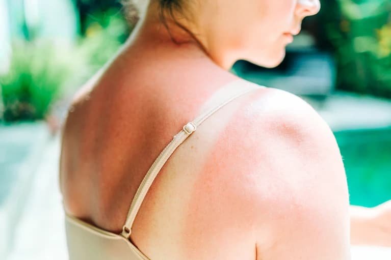Vacuna de ARNm reduce un 42 % el riesgo de recaída del melanoma