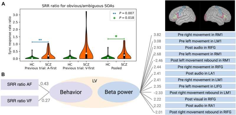 Una señal cerebral vincula varios síntomas de la esquizofrenia